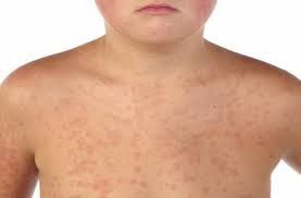 Brots de xarampió a Europa